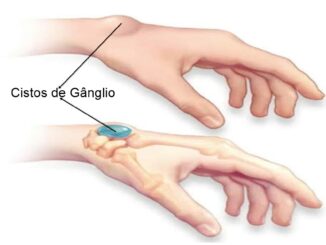 Cisto de gânglio ou calombo, o que são e como aparecem