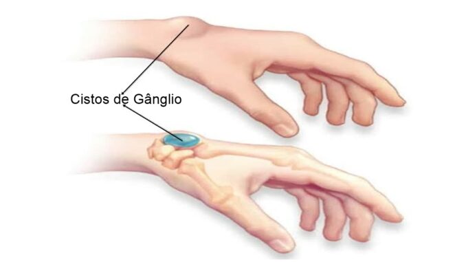Cisto de gânglio ou calombo, o que são e como aparecem