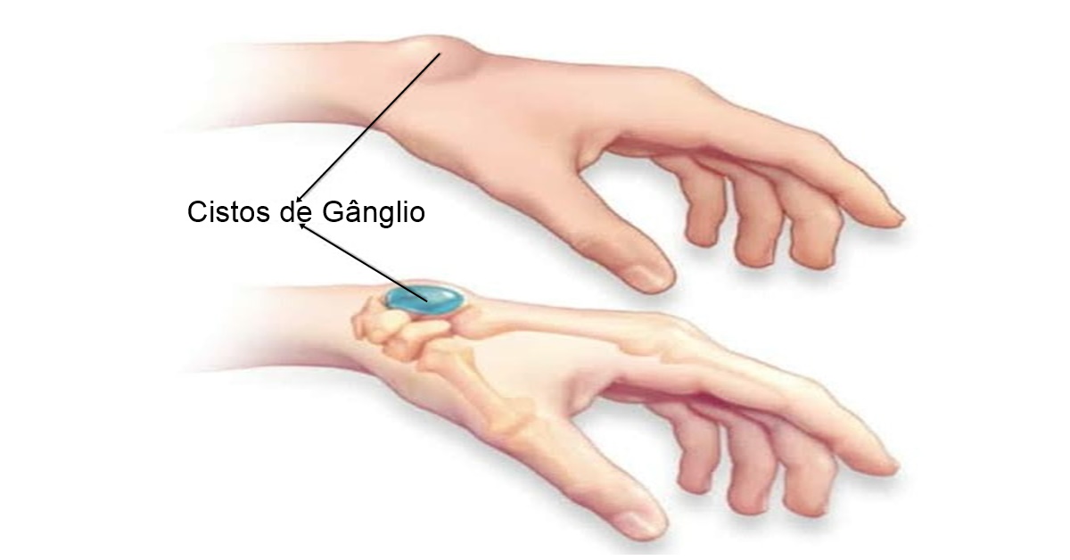 Cisto de gânglio ou calombo, o que são e como aparecem