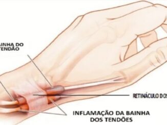 Tenossinovite: Condição que Afeta os Tendões