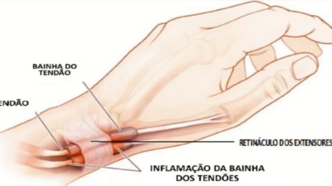 Tenossinovite: Condição que Afeta os Tendões